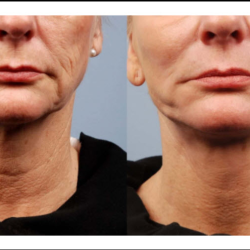 RF  Microneedling