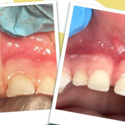 Interceptive Orthodontics/Space Maintenance