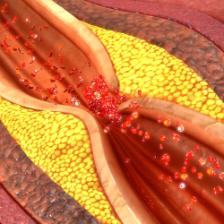 Coronary Artery Disease