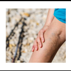 Varicose Veins