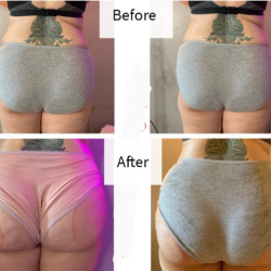 Brazilian Butt Lifts