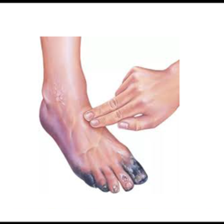 Critical Limb Ischemia