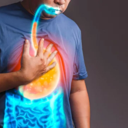 Gastroesophageal Reflux Disease (GERD) Management