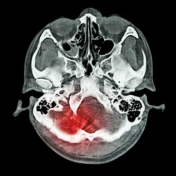 Skull Base Surgery