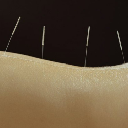 Acupuncture