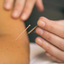 Acupuncture