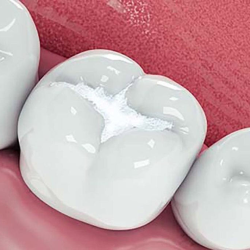 Fillings and Sealants