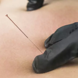  Dry Needling