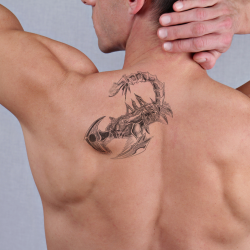 Laser Tattoo Removal