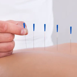 Acupuncture