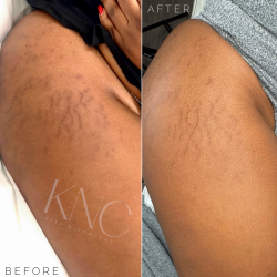 Scar/Burn Lightening 