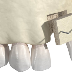 Bone Grafting