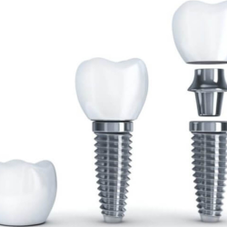 Dental Implants