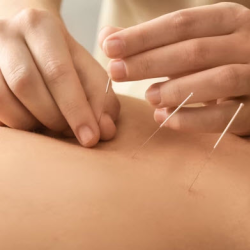 Acupuncture