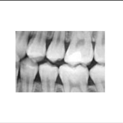 Digital X-rays