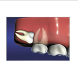  Wisdom Teeth