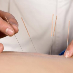 Acupuncture