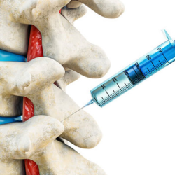 Facet Joint Injections