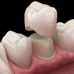 Dental Crowns