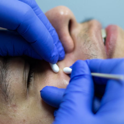 Advanced Acne Treatment
