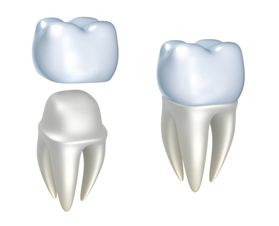 Dental Crowns