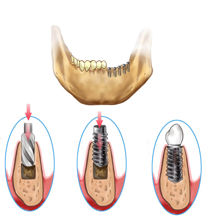 Dental Implants