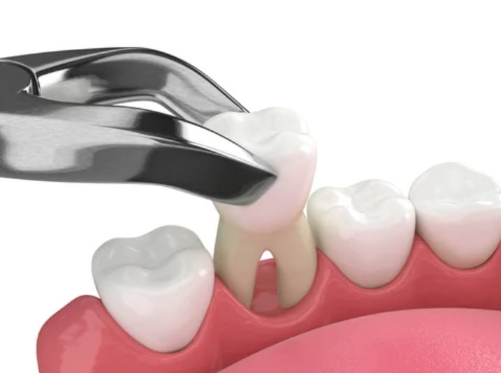 Tooth Extractions