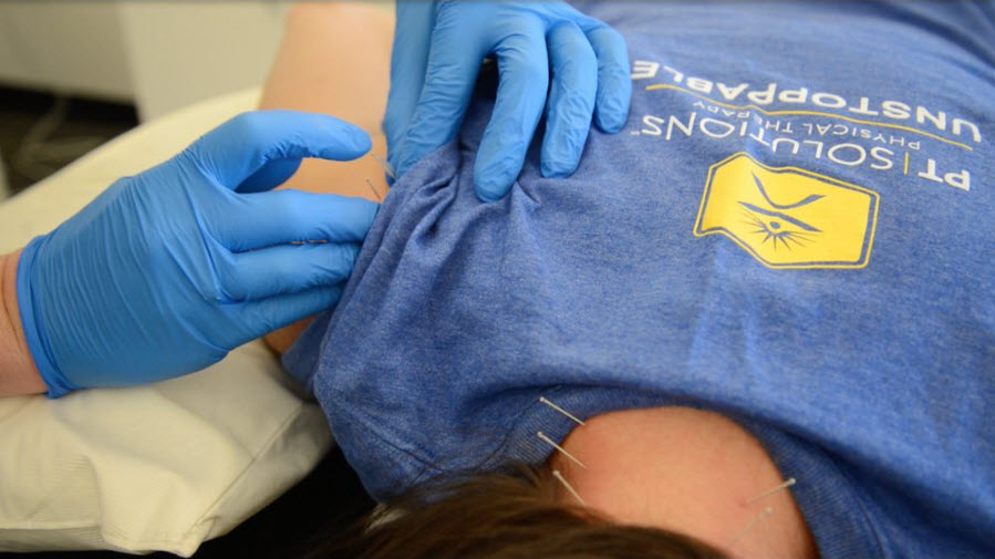 Dry Needling