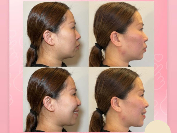 Dermal Fillers