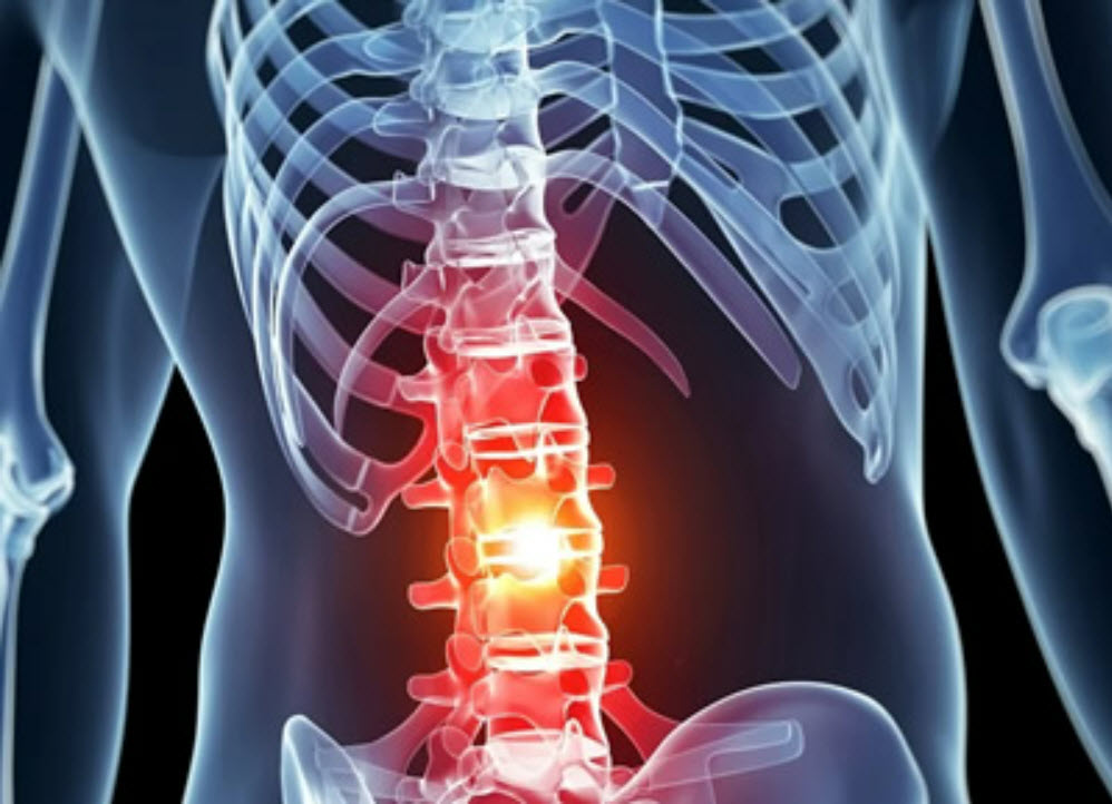 Spinal Cord Injury