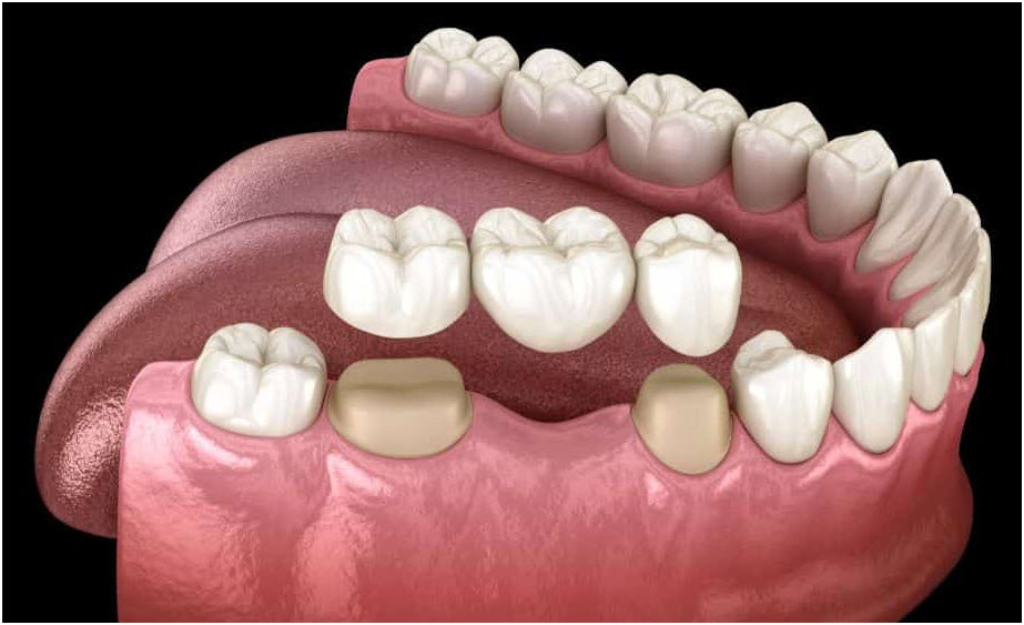 Dental Bridges