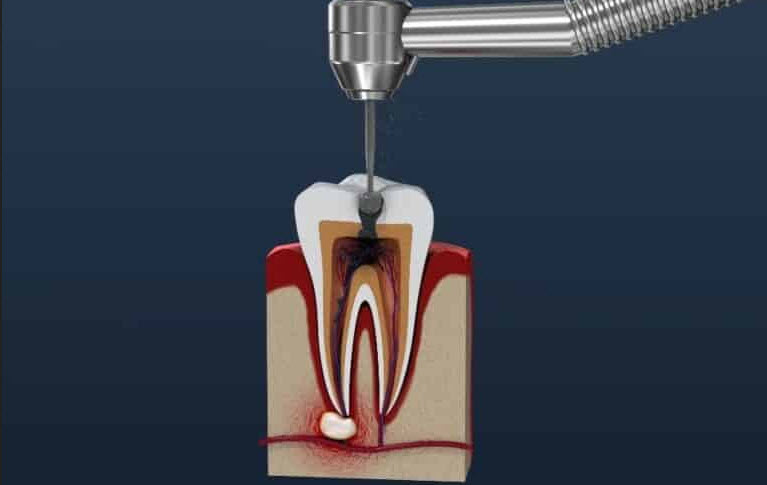 Root Canal Treatment