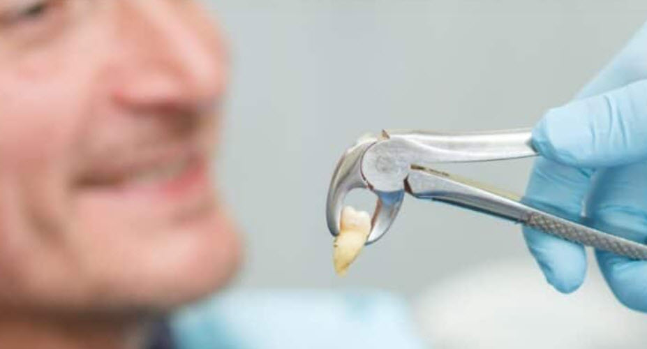 Dental Extraction near Roswell GA