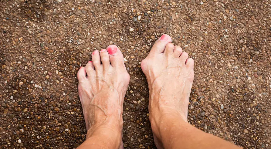 Bunions / Lapiplasty
