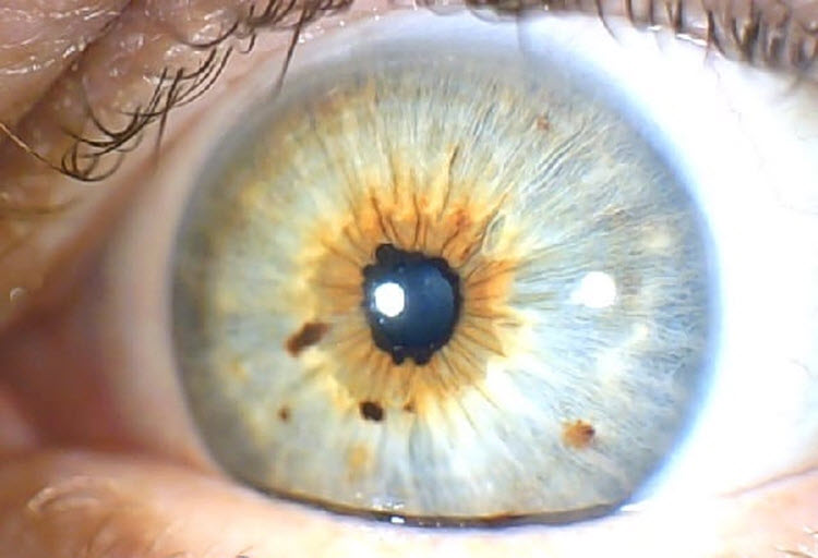 Iridology