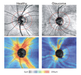 Optical Coherence Tomography (OCT)