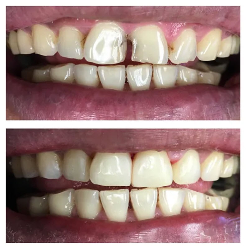 Dental Fillings