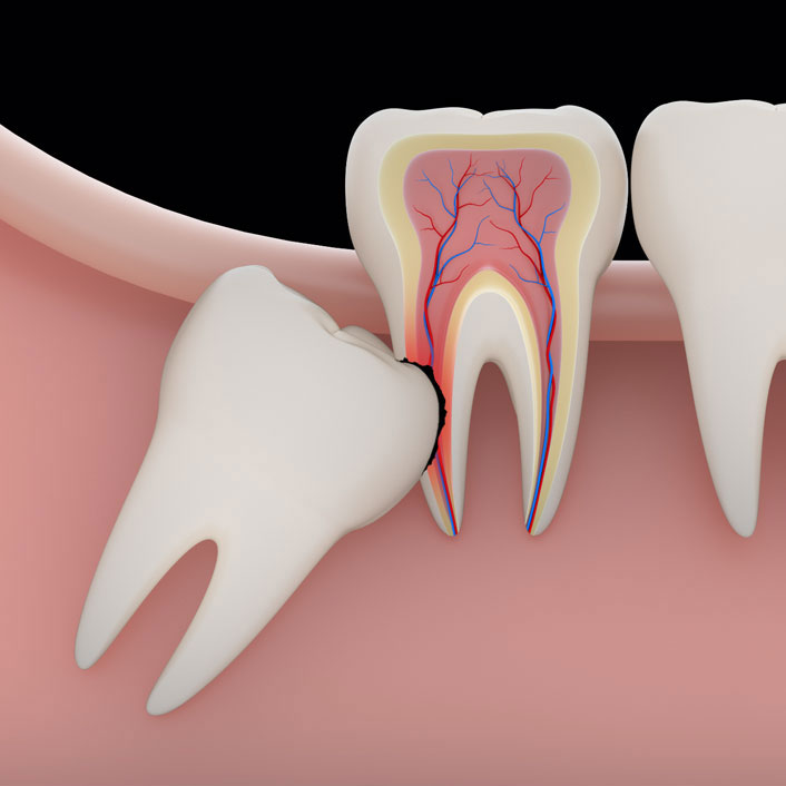 Wisdom Teeth