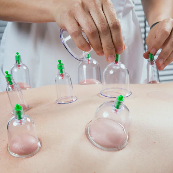 Cupping