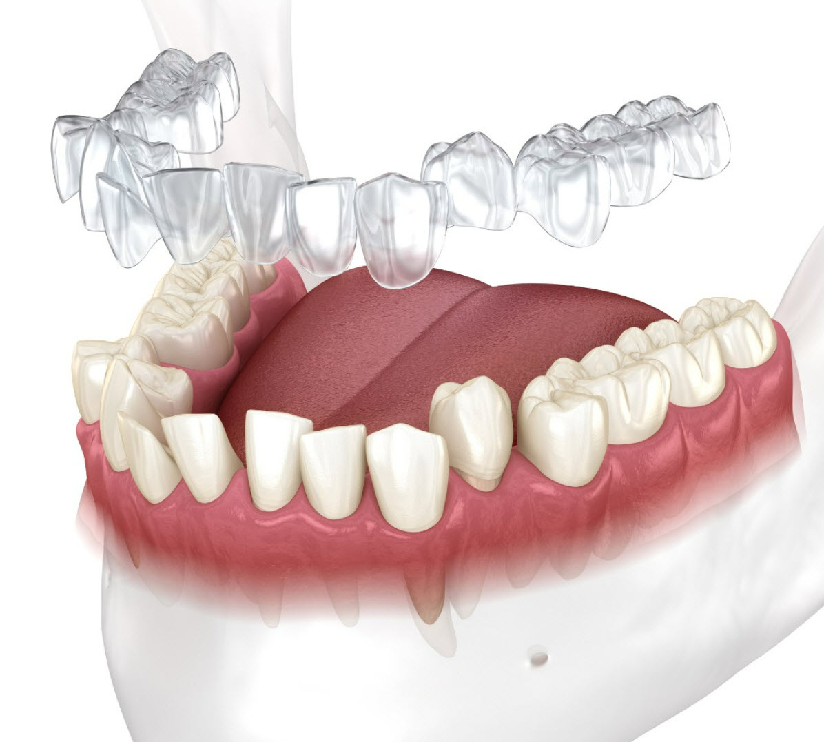 Clear Braces