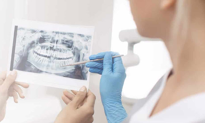  Dental Implants