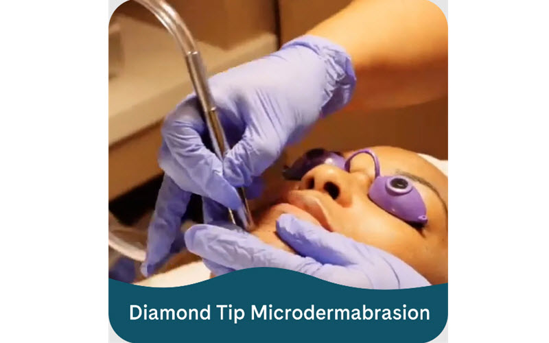 Microdermabrasion