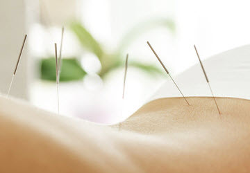 Acupuncture
