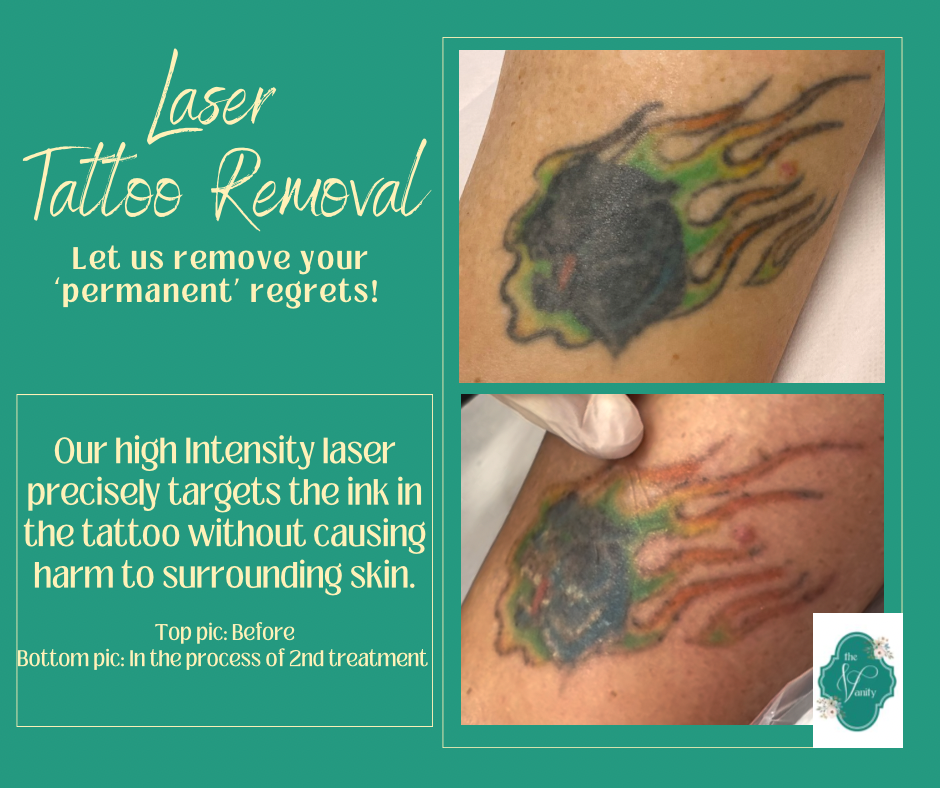 Laser Tattoo Removal