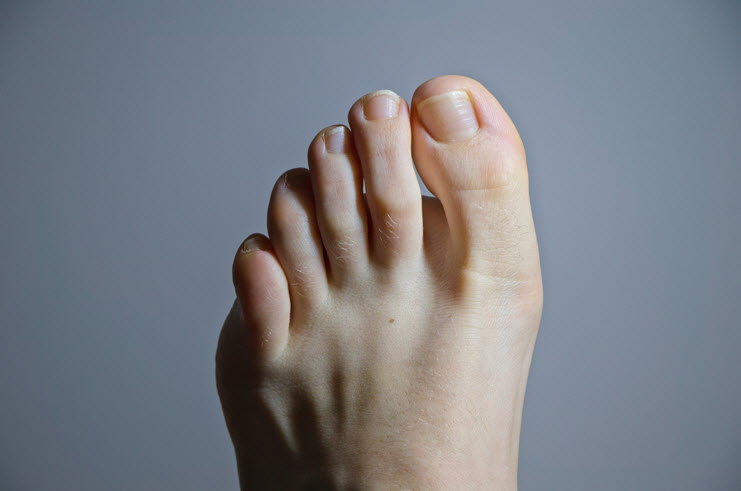 Hammertoe Correction