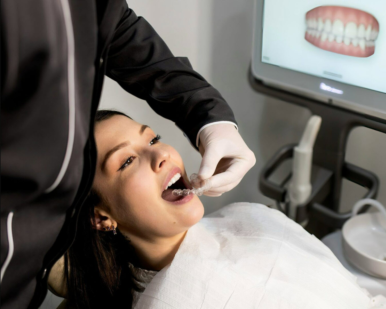 Clear Aligners