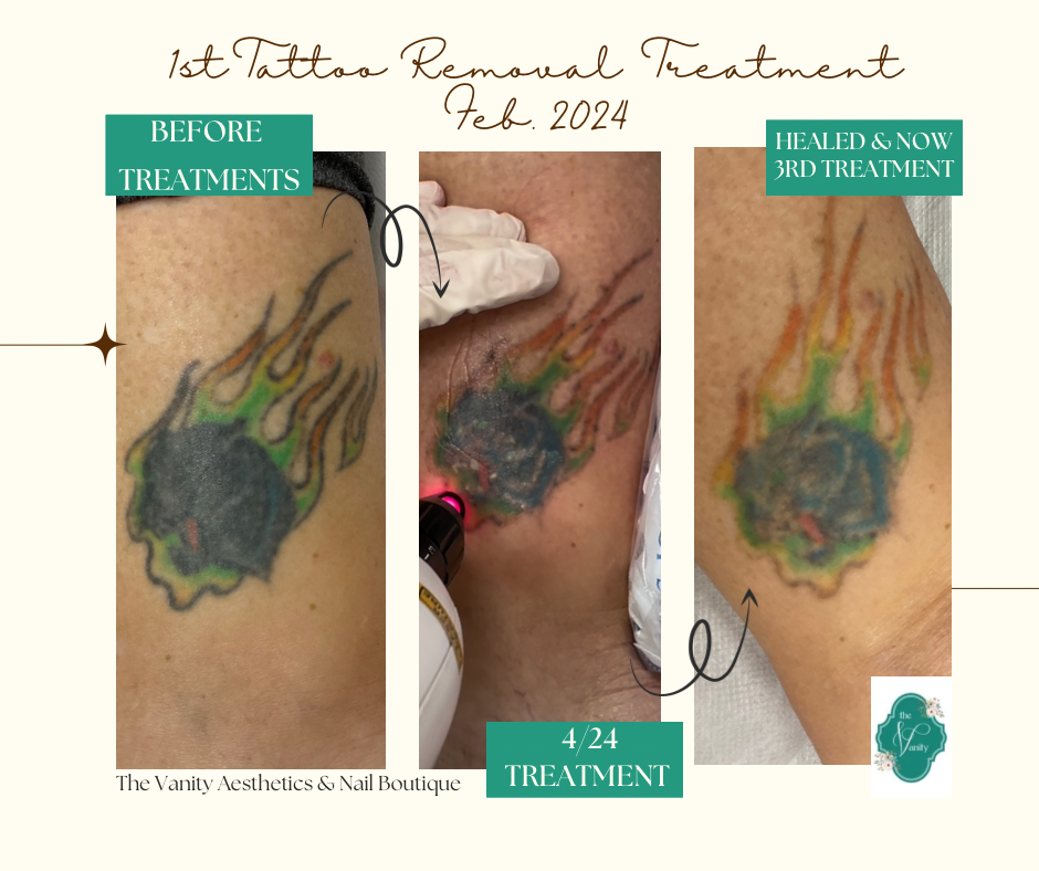 Laser Tattoo Removal