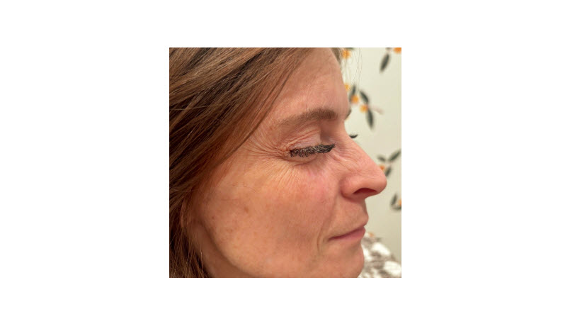 What to expect with Botox Treatments