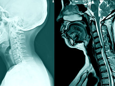 Degenerative Disc, Bulging 