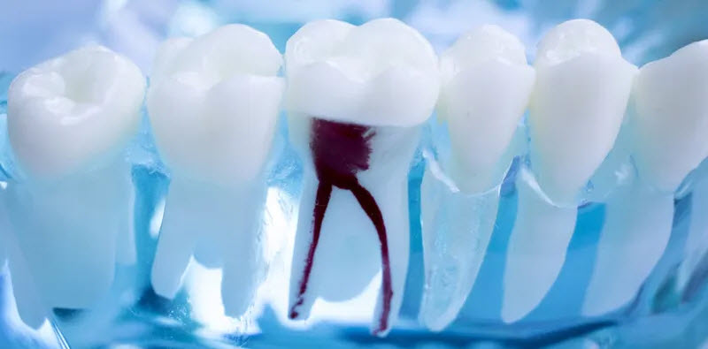 Root Canal Therapy